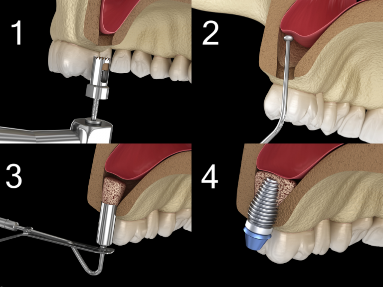 Sinus Lift Vs Bone Graft Differences And Similarities