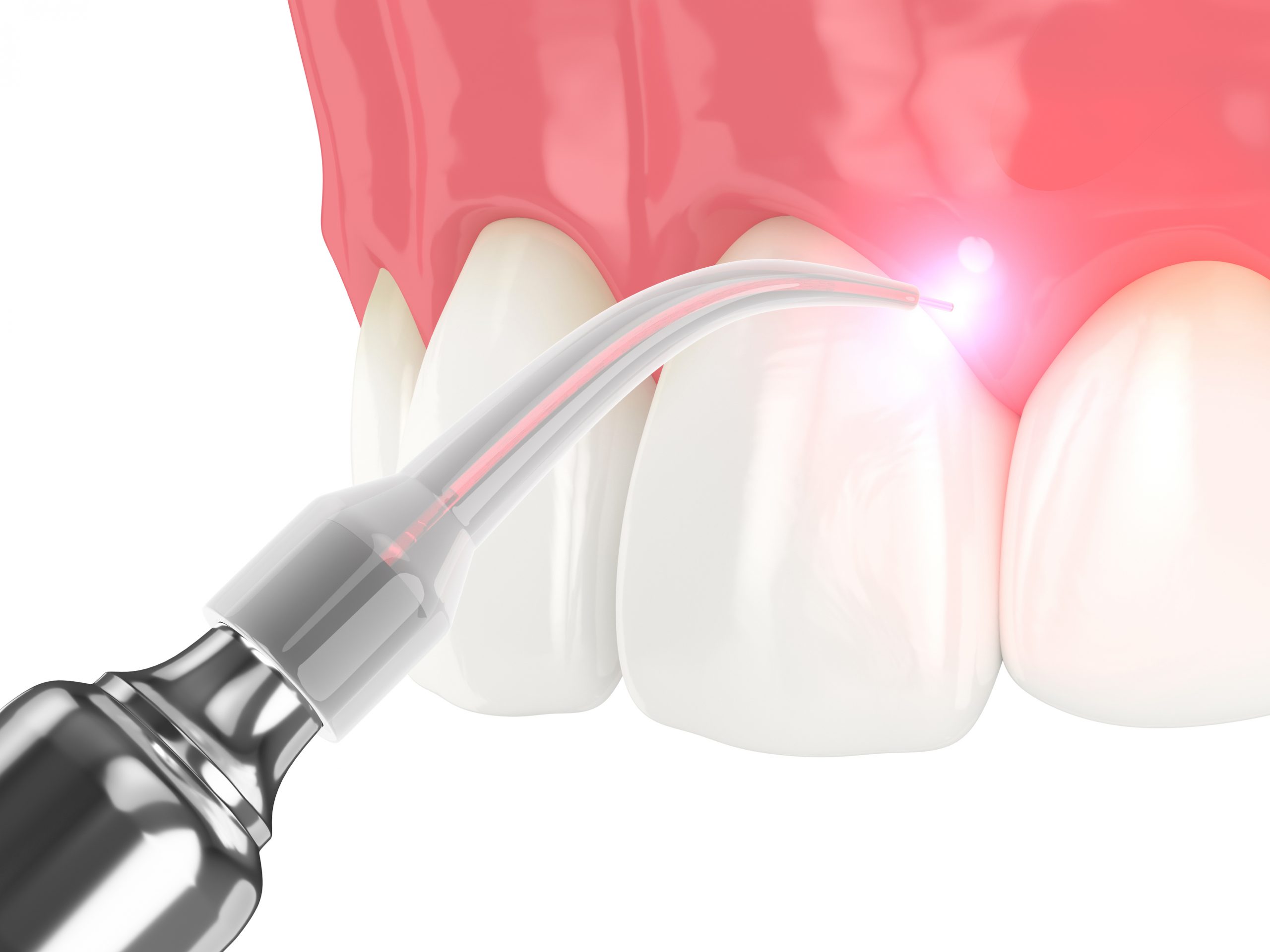 laser diode to treat gums.