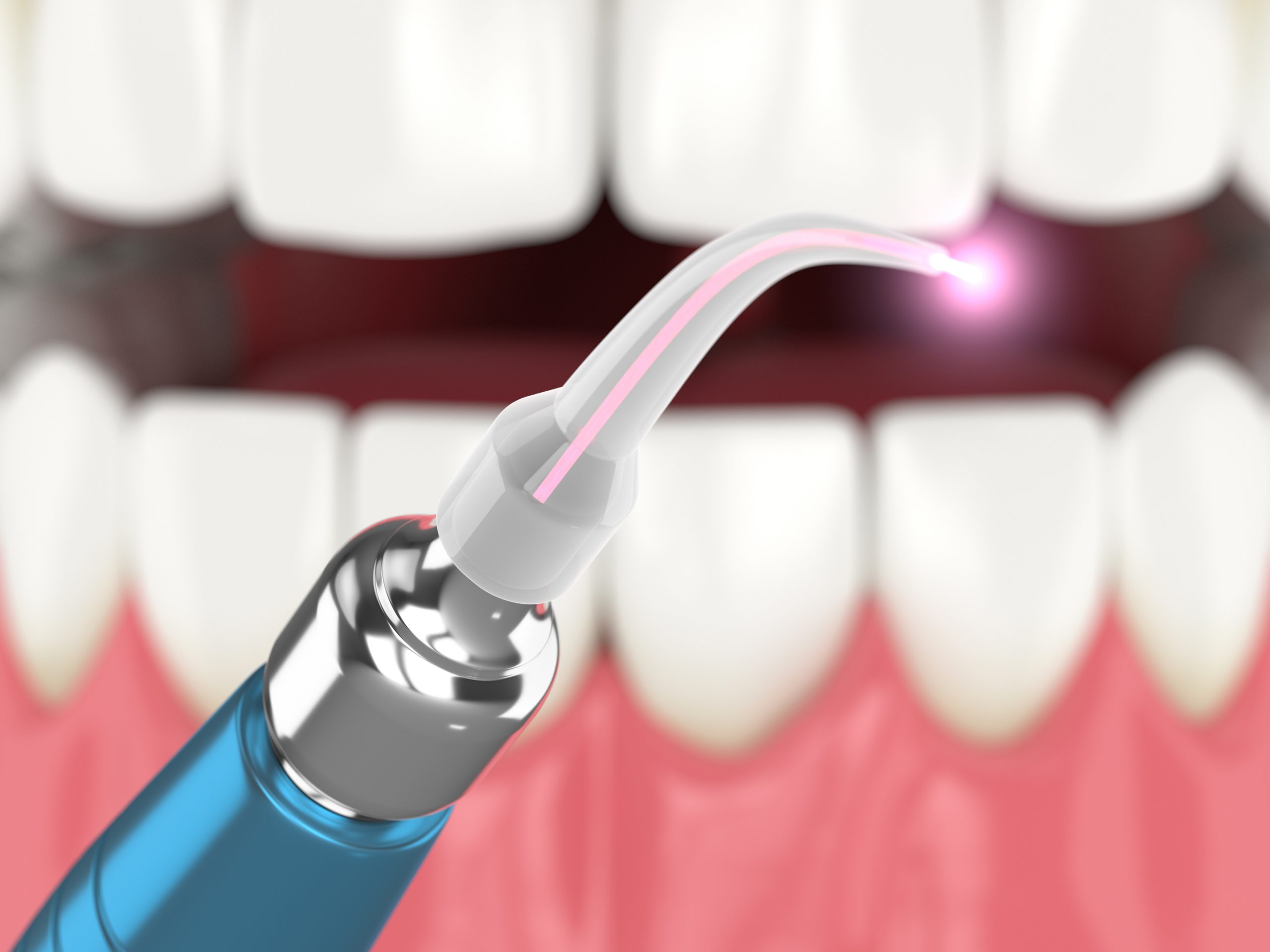 LANAP laser for periodontal therapy in Long Island, NY