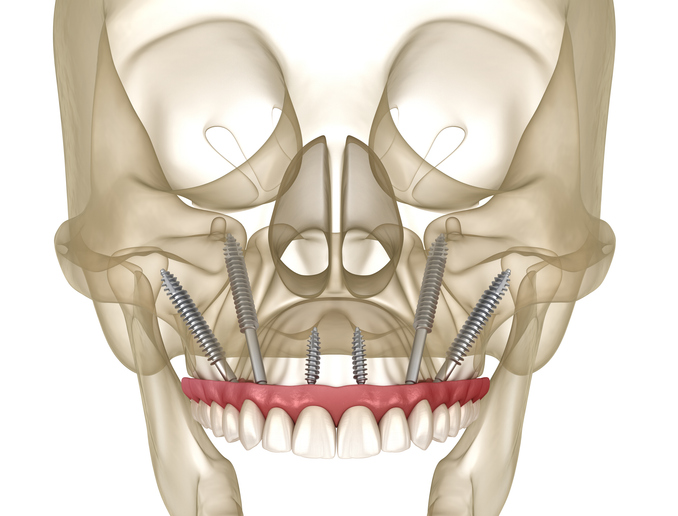 Zygomatic Implants X-ray 3D illustration 