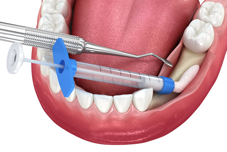 Bone grafting augmentation for tooth implantation.