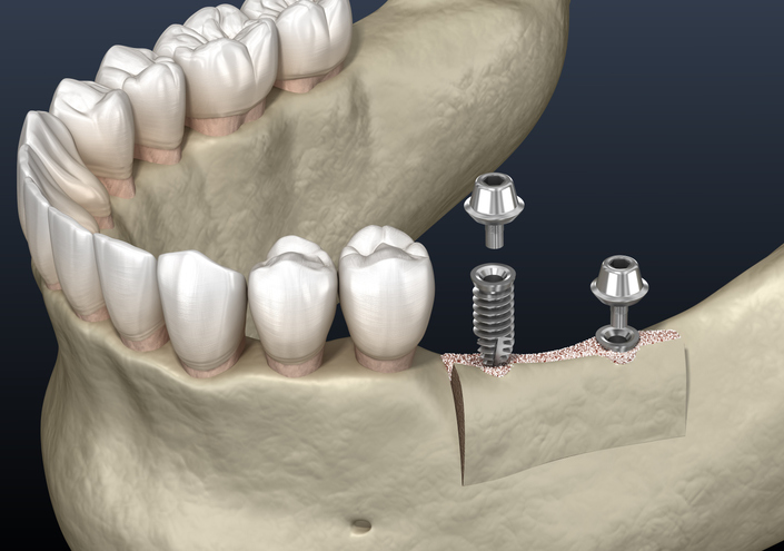 bone graft and synthetic material for dental implants