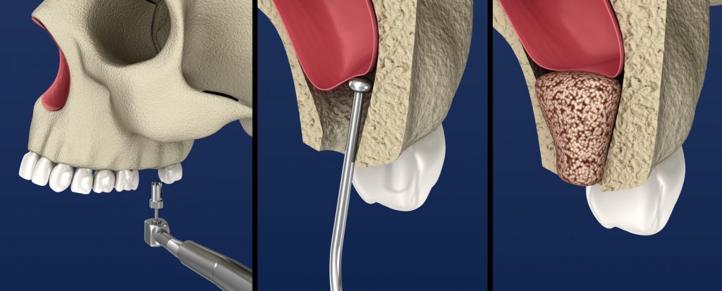 Sinus Lift Surgery. Sinus Augmentation. 3D illustration
