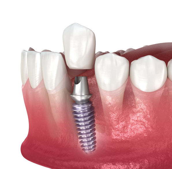 Dental implants and crown