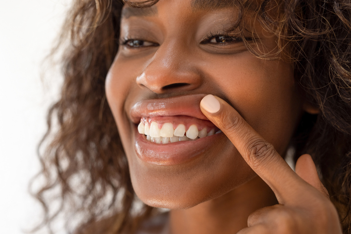 gum depigmentation treatment. Ethnic woman showing her gums.