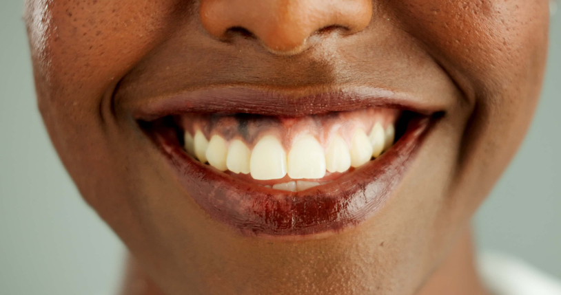 Ethnic woman with splotchy gum tissue.