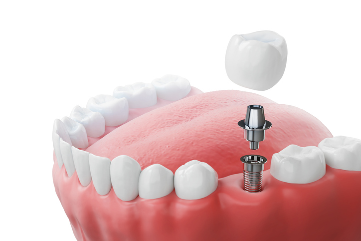 Parts of a dental implant