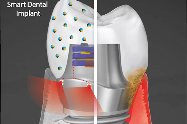 Red-Light Therapy Dental Implants